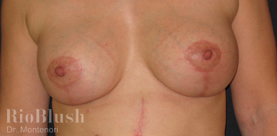 Scar marks before